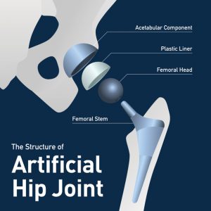 Structure of the artificial hip joint.