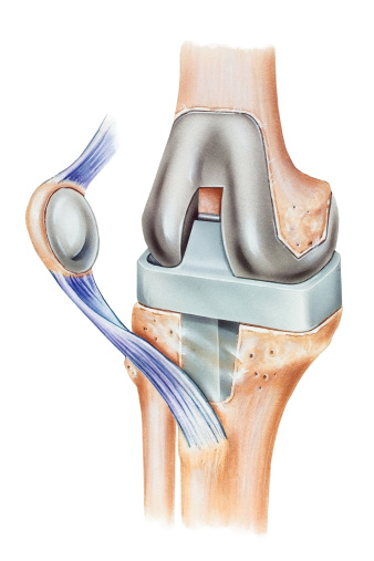 Knee replacement