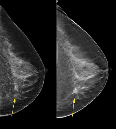 A new dimension in mammography – Welia Health