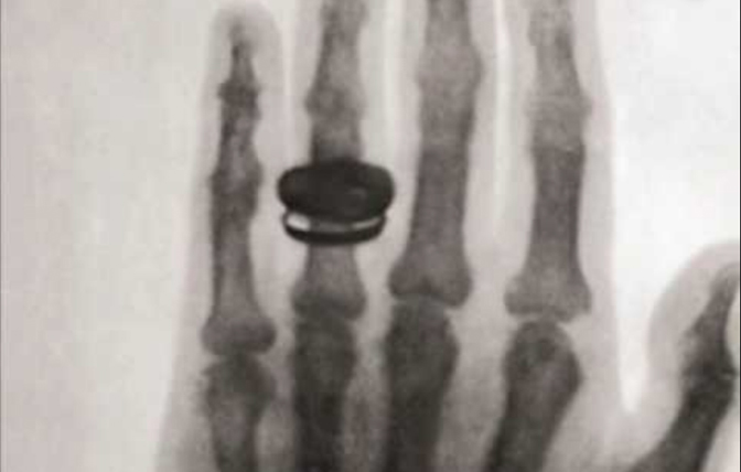 Image of the first xray