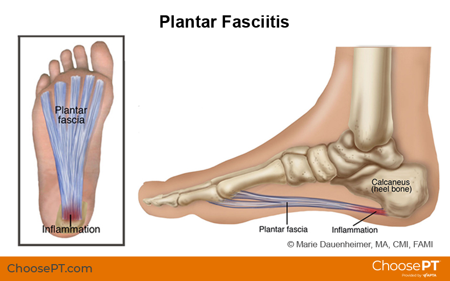 Non-Surgical Rehabilitation for Achilles Tendon Injuries - The Orthopaedic  Foot & Ankle Center