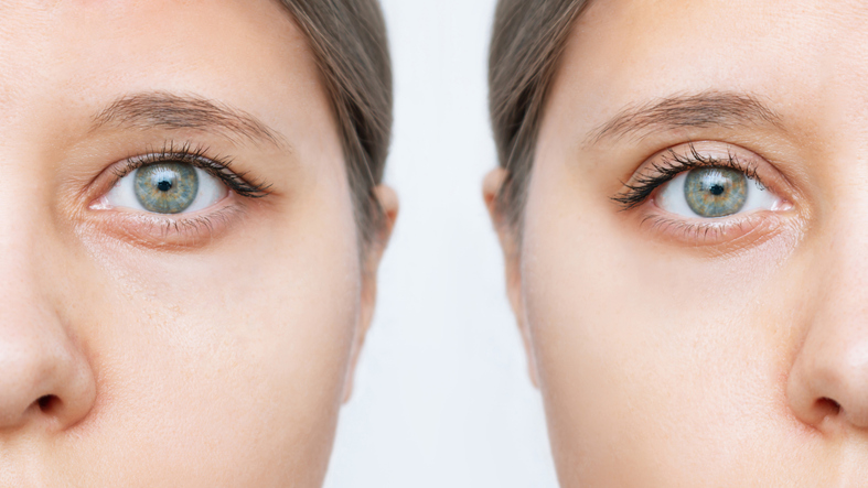 Closeup of a woman's face with drooping upper eyelid before and after blepharoplasty