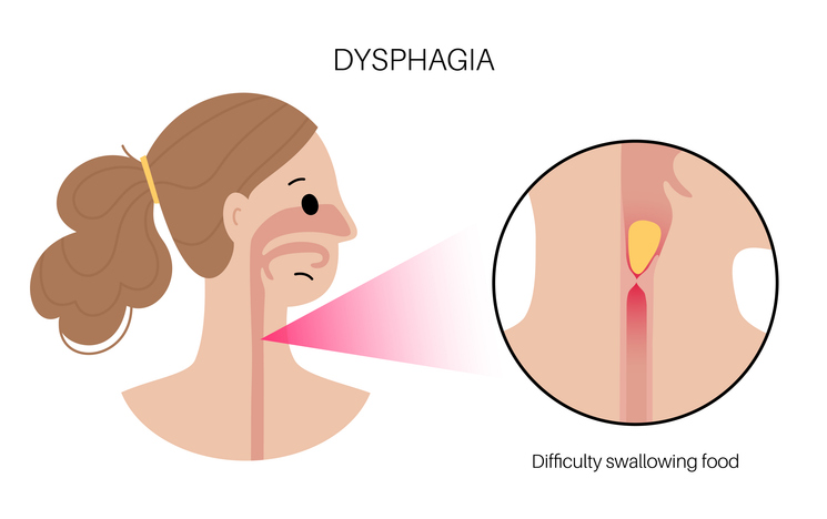 Illustration of dysphagia showing food having difficulty passing in the esophagus